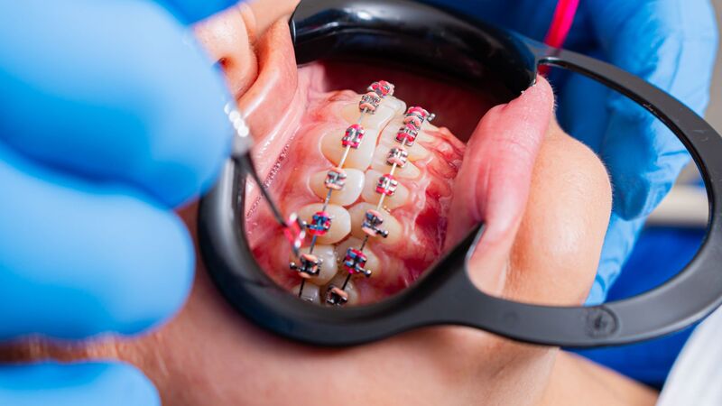 Close-up of dental braces fitted by an Auckland orthodontist